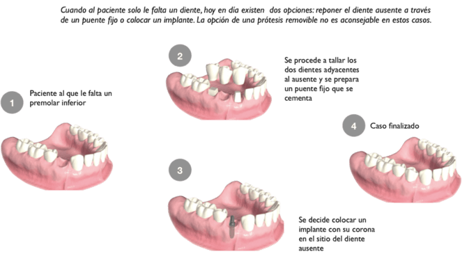 Tipos de prótesis dentales Martín Encabo